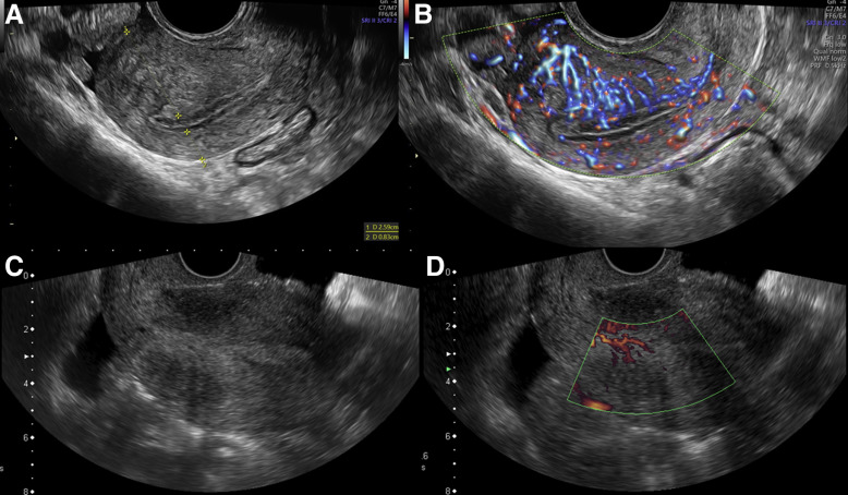 endometrial cancer