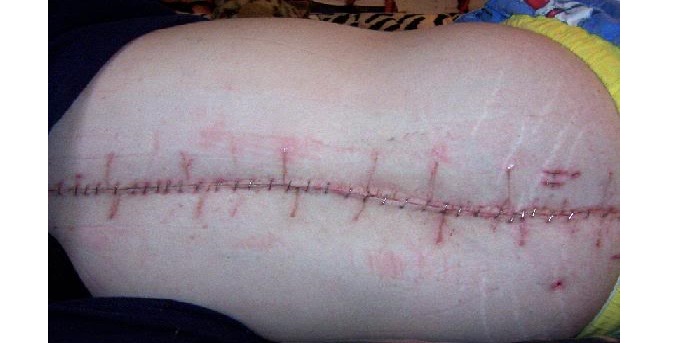 spinal fusion for a herniated intervertebral disk