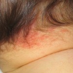 strok-bites on baby back & neck