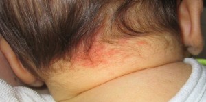 strok-bites on baby back & neck