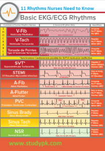 Basic ECG/EKG Rhythms NCLEX Cheat sheet