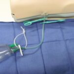 mediastinal chest tube