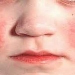 Child Reye's Syndrome