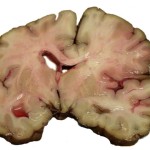 Stroke Brain Human
