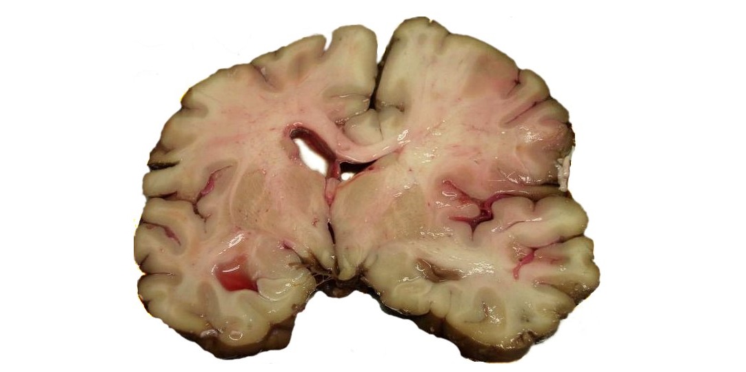 Stroke Brain Human