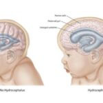 birth of a neonate with anencephaly