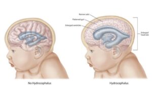 birth of a neonate with anencephaly