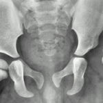 Developmental Dysplasia of the Hip