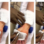 radial arterial line