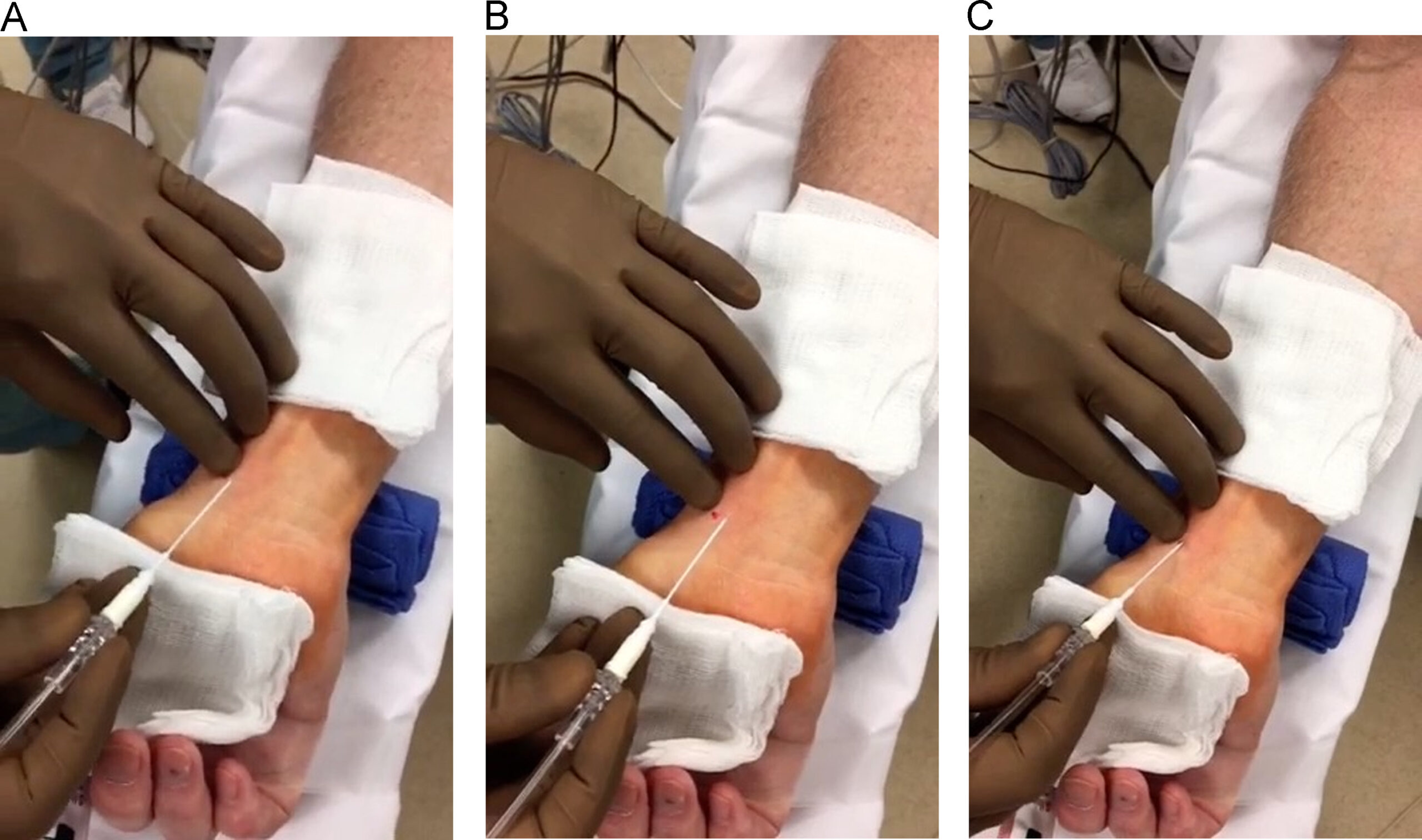radial arterial line