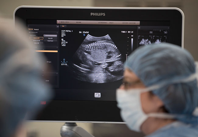 spina bifida
