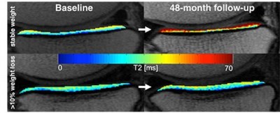 MRI Knee Weight Loss