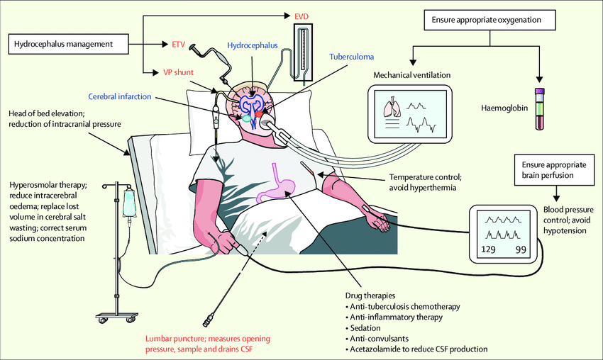 Increase pressure. Perfusion Pressure. Cerebral Salt wasting pathogenesis. Cerebral perfusion Pressure and intracranial Pressure. High intracranial Pressure ECG.