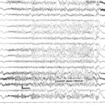 ictal phase