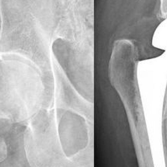 NCLEX Femoral Neck Fracture Practice Questions StudyPK