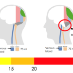 sustained increased intracranial pressure