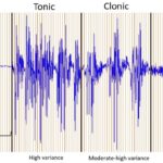 tonic-clonic seizure