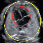 fetal heart The chamber closest to the fetal spine is the left atrium