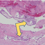 wall of the fallopian tube