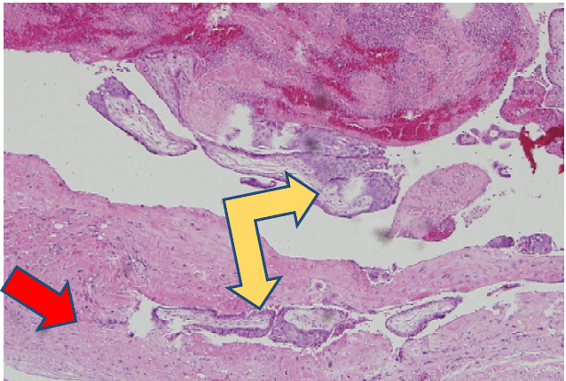wall of the fallopian tube