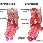 Diverticulitis & Appendicitis NCLEX