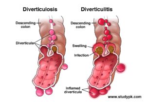 Diverticulitis & Appendicitis NCLEX