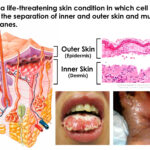 Stevens-Johnson syndrome