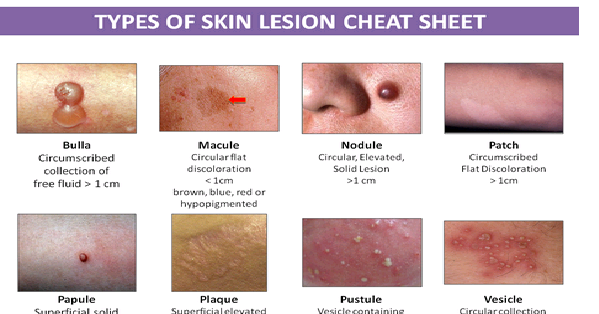 Types Of Skin Lesion Studypk