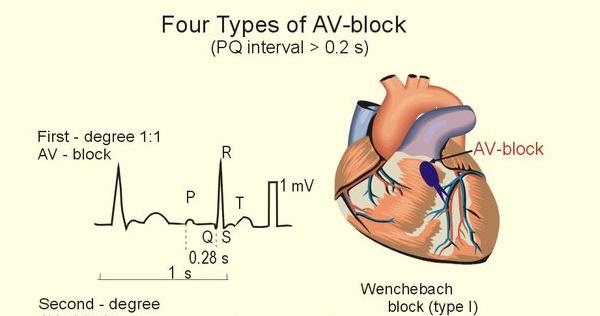 Four Types of AV-Block