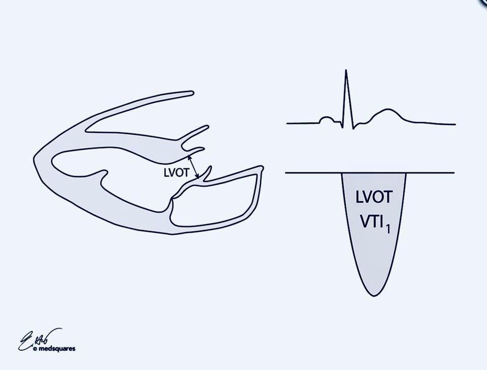 CCU_ECHO PulmonarySystemic Shunt Ratio { Qp / Qs } StudyPK