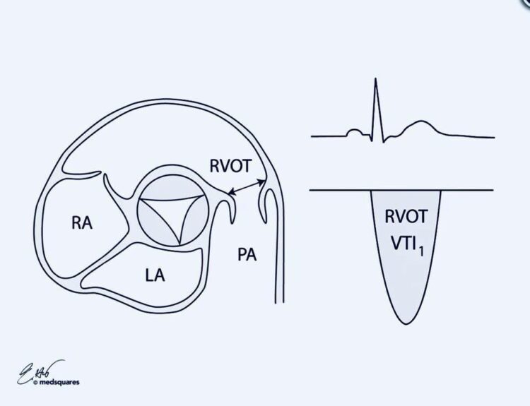 CCU_ECHO PulmonarySystemic Shunt Ratio { Qp / Qs } StudyPK