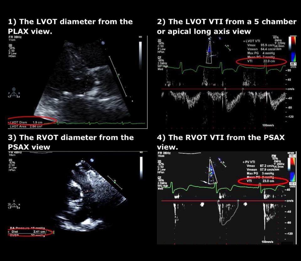 CCU_ECHO PulmonarySystemic Shunt Ratio { Qp / Qs } StudyPK