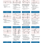 Can’t Miss ECG Findings Cards for the Emergency Medicine Provider