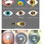 Normal Cornea vs Stages of Keratoconus Cheat Sheet