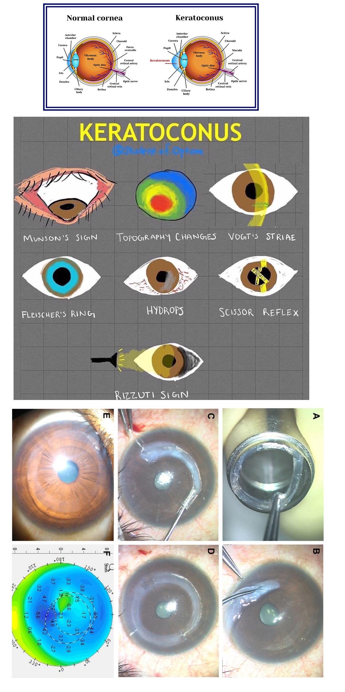 Normal Cornea vs Stages of Keratoconus Cheat Sheet