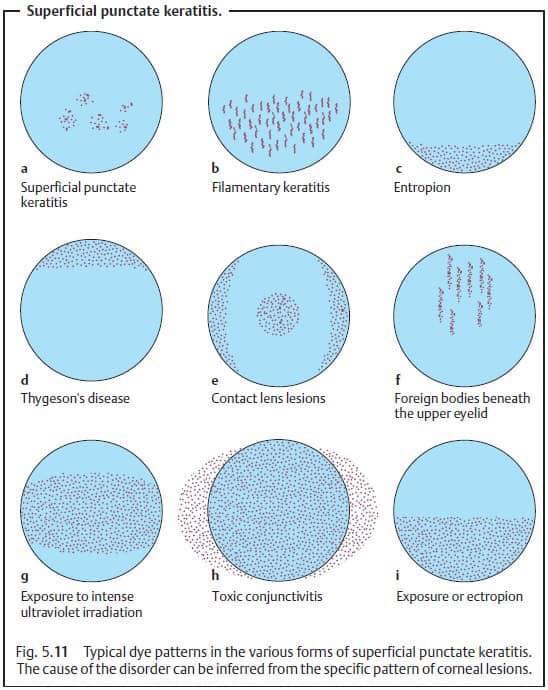 Superficial Punctate Keratitis – Eye Disorders