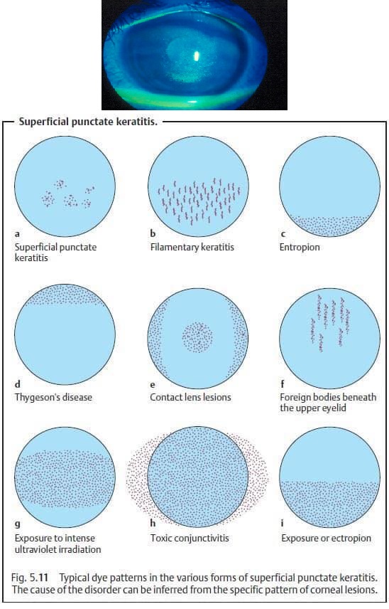 Superficial Punctate Keratitis Treatment Eye Disorders