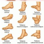 Congenital Talipes Equinovarus (Clubfoot) Nursing Cheat Sheet