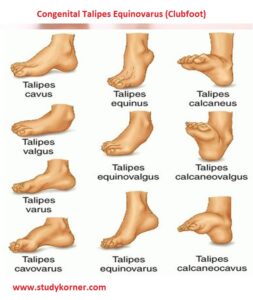 Congenital Talipes Equinovarus (Clubfoot) Nursing Cheat Sheet