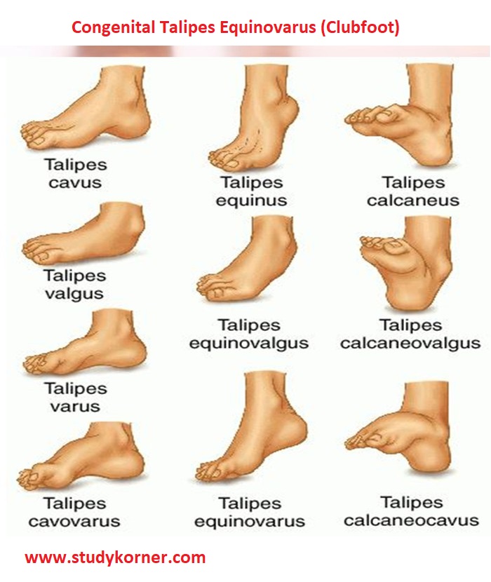 Clubfoot: Symptoms, Causes & Treatment