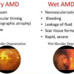 dry age-related macular degeneration (AMD)