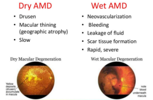 dry age-related macular degeneration (AMD)