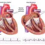 Atrial fibrillation