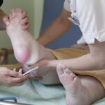 Stages of Pressure Sores