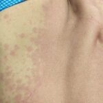 Vancomycin induced infusion syndrome