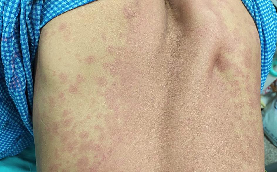Vancomycin induced infusion syndrome