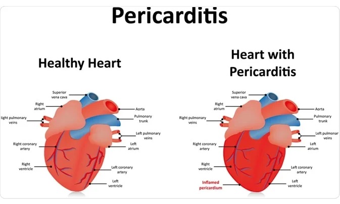 NCLEX Practice Question: Identifying Critical Clinical Findings in Acute Pericarditis