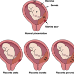 Accreta placentation