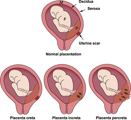 Accreta placentation
