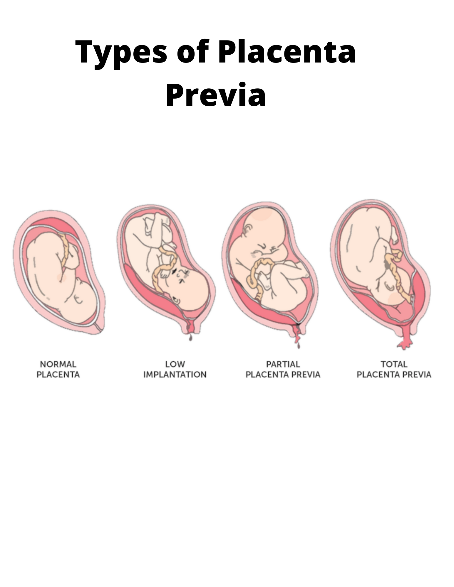 Types of Placenta Previa: Understanding Implications and Risks for Pregnancy and Delivery